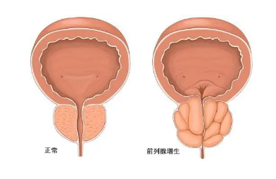 两性健康 | 对于女性来说，最怕男人得什么病？